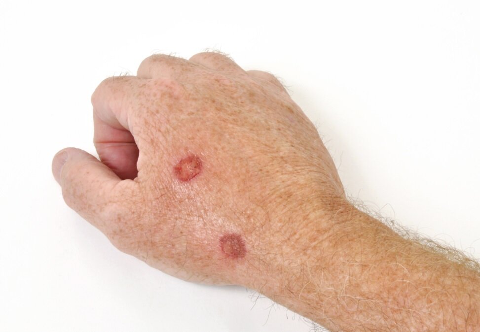 سرطان پوست را با نیش حشرات اشتباه نگیرید