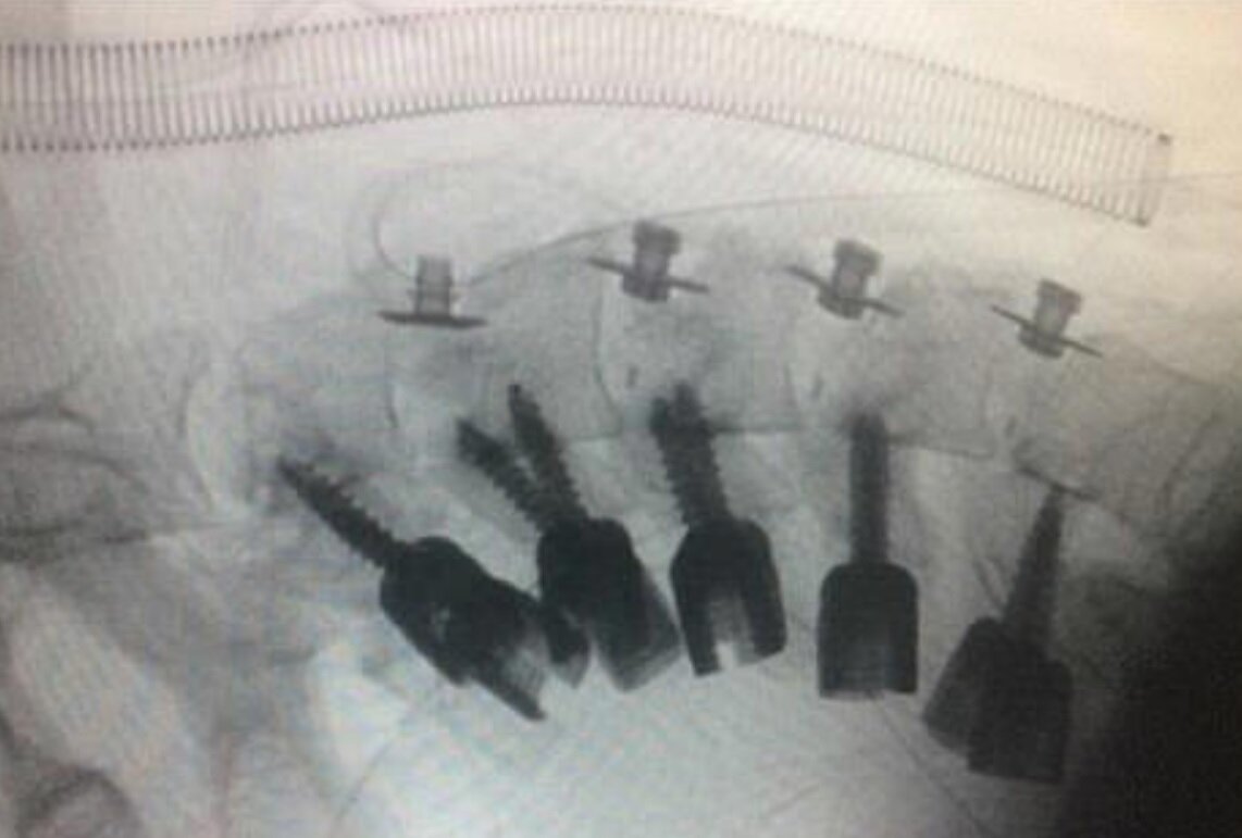 بیماری سندرم سر افتاده چه علائمی دارد؟/ عکس