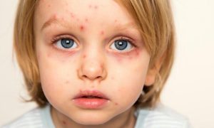 ببینید| اگر در کودکی آبله‌مرغان نگرفته‌اید...