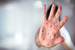 شناسایی ۶۷۴ ابتلا به سرخک در سال گذشته/ هشدار؛ تبلیغات علیه واکسیناسیون در
