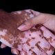 روشی برای کاهش لک‌های پوستی در ایران